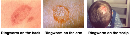 Ringworm on the back, ringworm on the arm, ringworm on the scalp