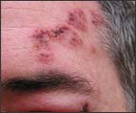 people_shingles3a.jpg Shingles facial rash and swollen eyelids.