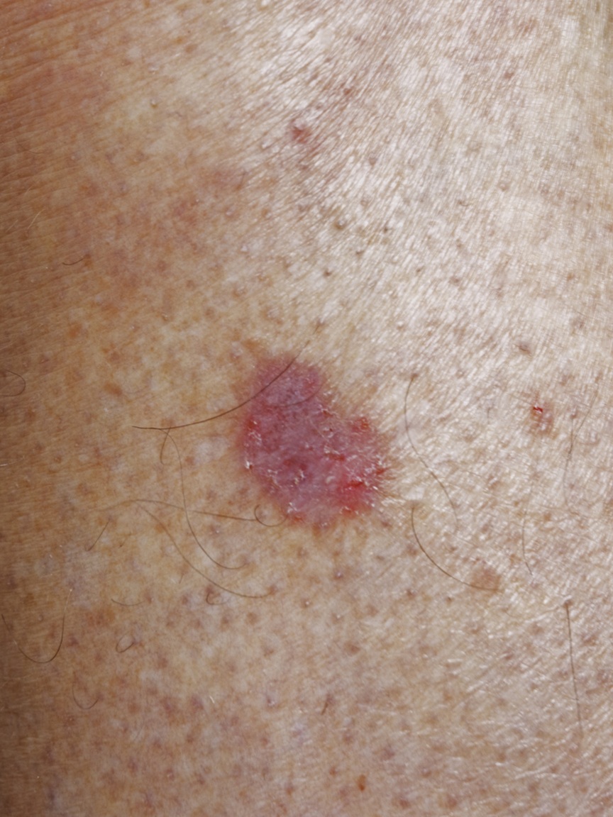 basal cell carcinoma on a man's leg