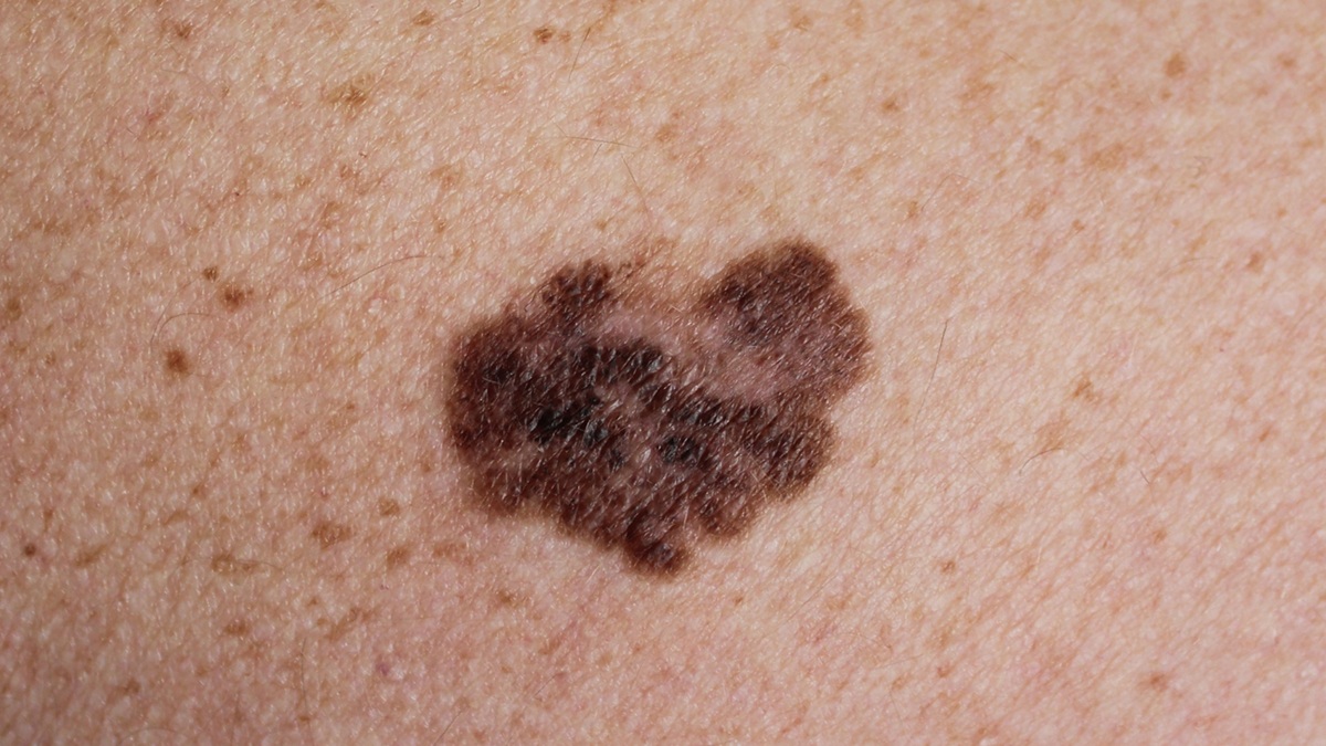 melanoma on the skin