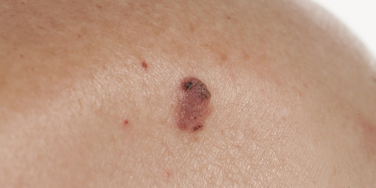 Squamous cell carcinoma on a man's back