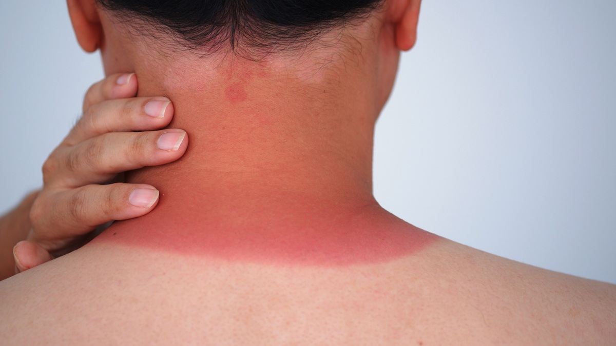 A man putting his hand on a sunburned area on the back of his neck