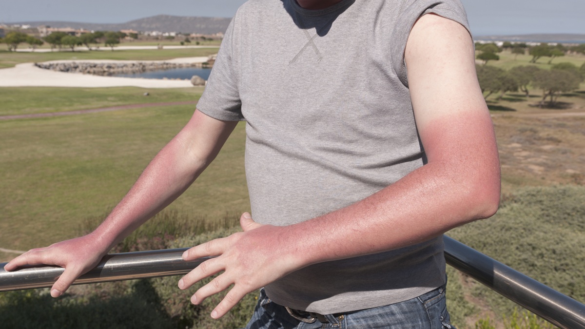 A man with sunburn on his arms standing outside