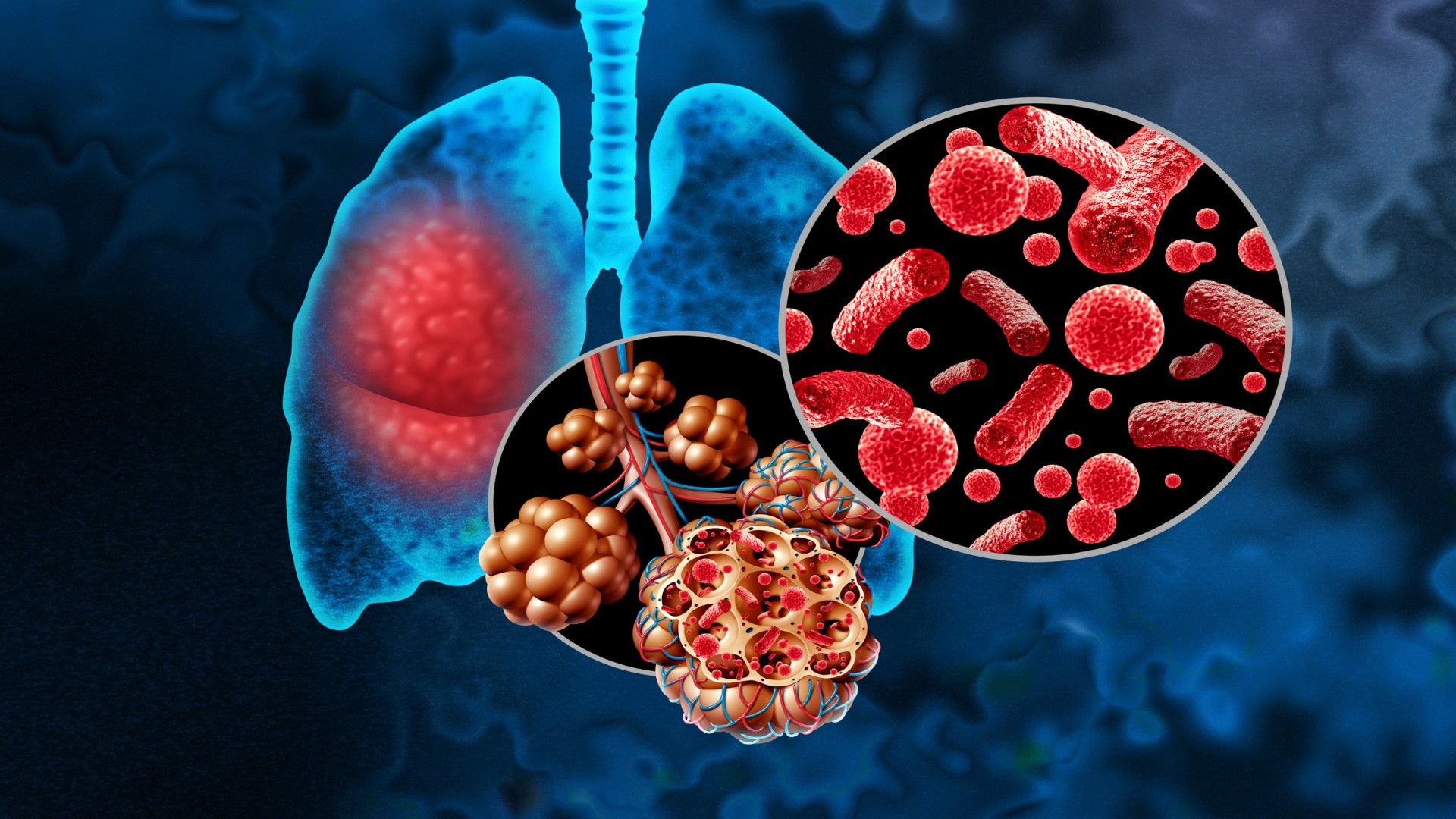 Bacterial Pneumonia or Pneumonia in the Lungs, illustration