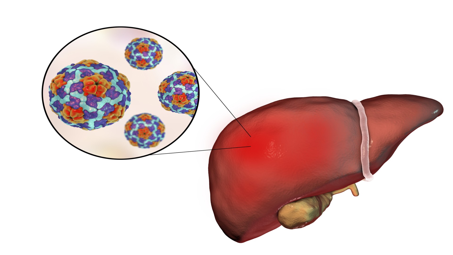 Hepatitis A illustration