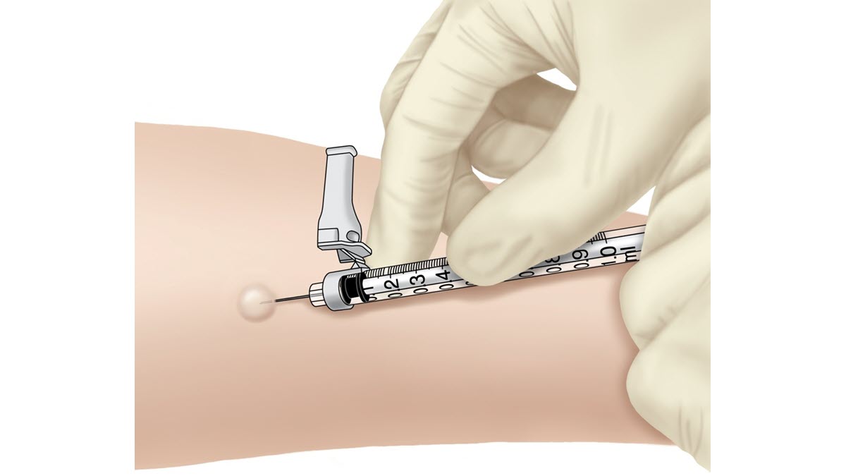 Administering the TB skin test Illustration showing the correct way to administer the TB skin test