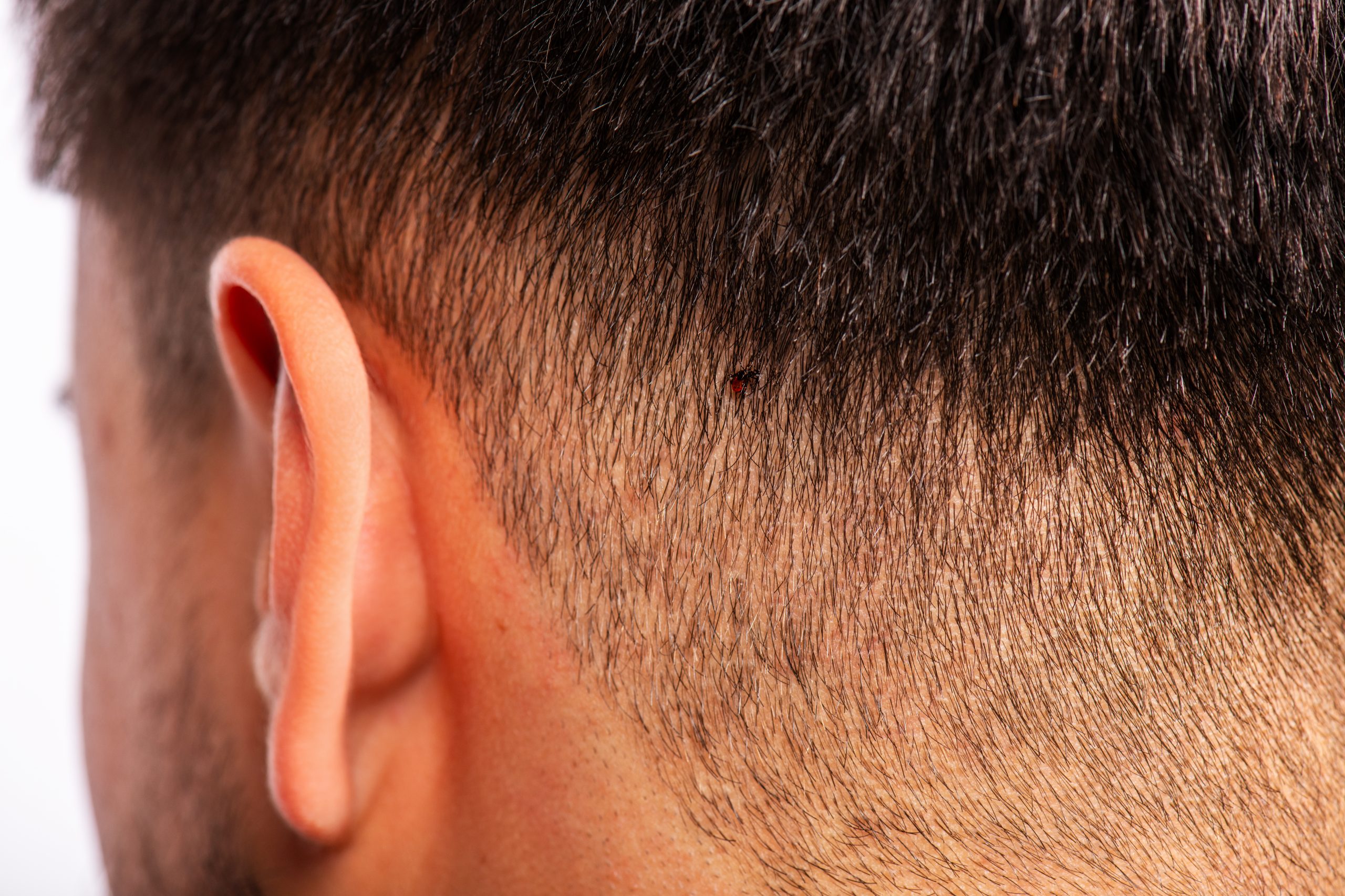 Una garrapata en el pelo de un hombre, que muestra lo fácil que es que las garrapatas se camuflen.