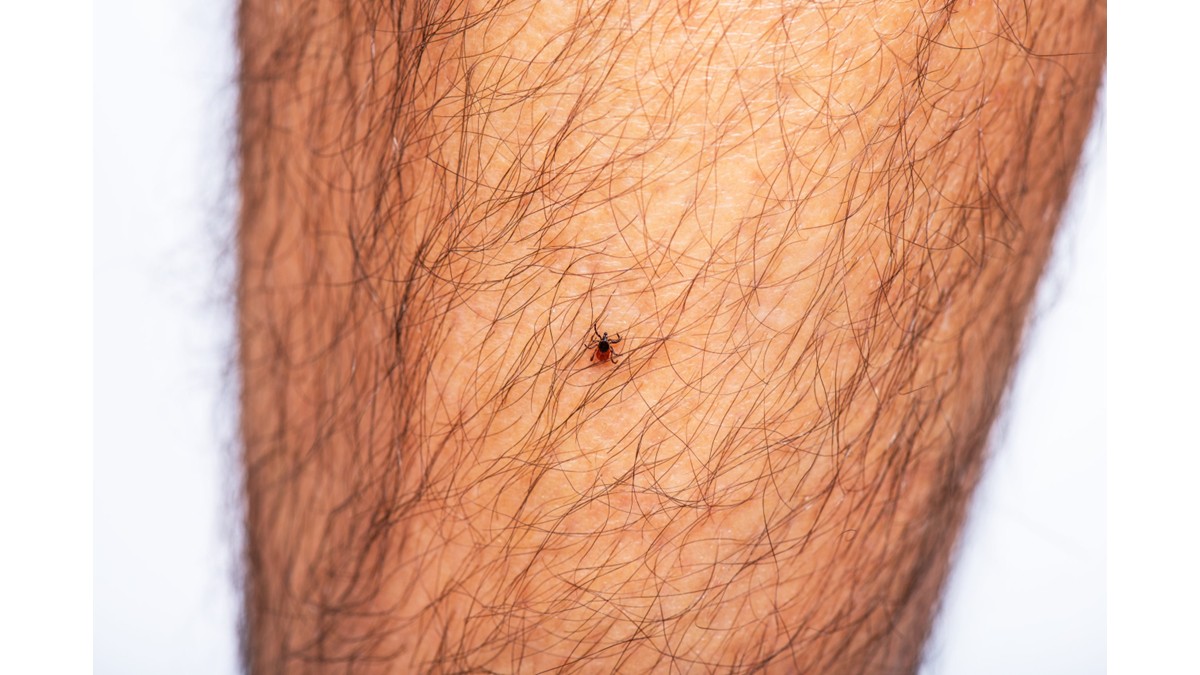 Una garrapata de patas negras caminando en la pierna de un hombre.
