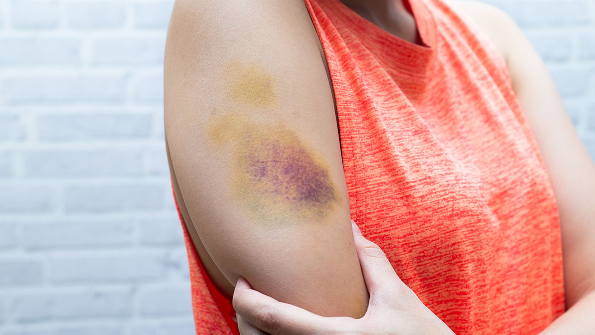 Woman holding her arm that has a large purple and yellow bruise on it