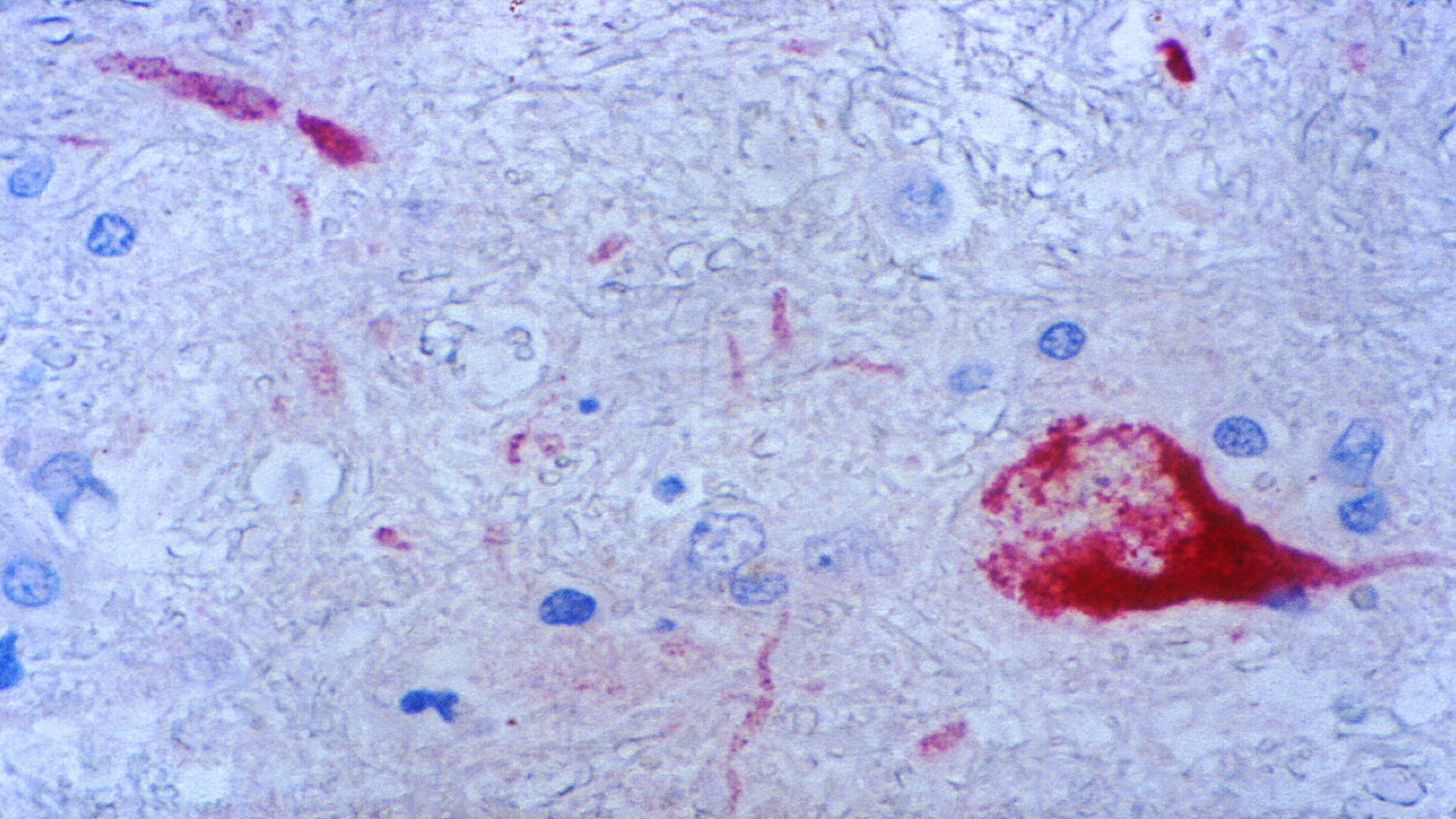 Microscopic image of tissue with West Nile virus infection.