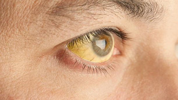Yellowed eye with jaundice.