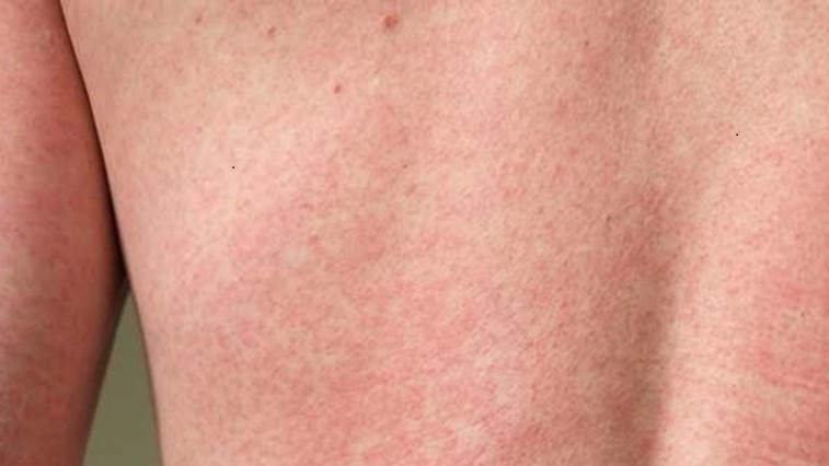 Posterior view of a patient’s back upon presenting; this blotchy rash was caused by the Zika virus.