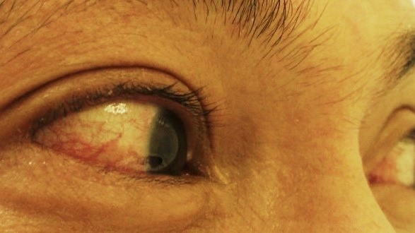 Closeup of a person's eyes with conjunctivitis (red eye).